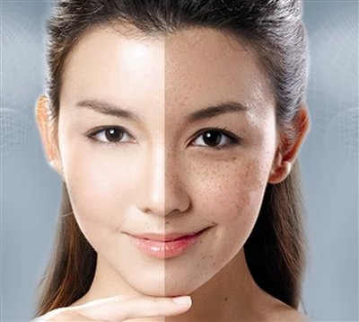 脸上长斑到底有那些原因呢?
